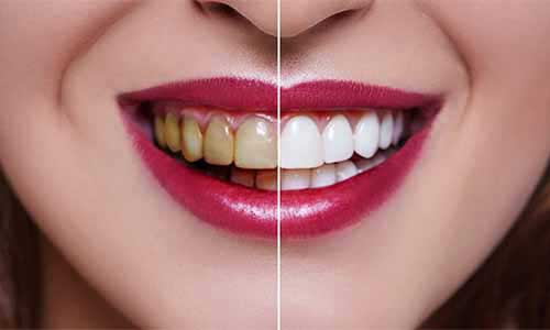 Teeth whitening at Nithya Dental Clinic Virugambakkam Chennai